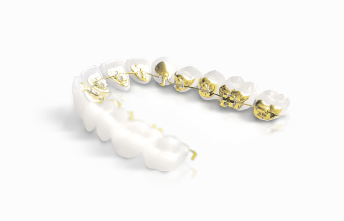 The Smile Space orthodontie - L’appareil dentaire lingual