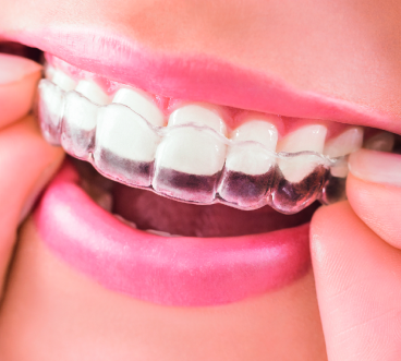 The Smile Space - Les gouttières invisalign