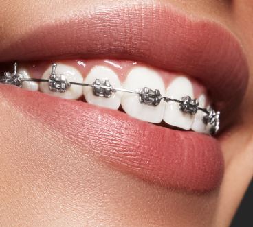 The Smile Space - l’appareil métallique